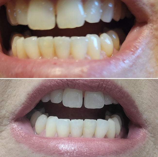 Before and after images showing yellow teeth transformed to a whiter shade.