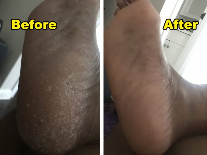 A split before-and-after image showing a reviewer’s foot: dry and cracked on the left, moisturized and smooth on the right.