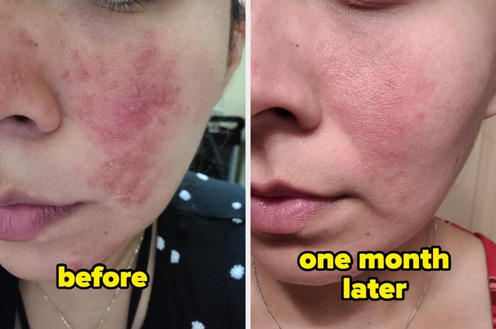 Before-and-after comparison showing a person's skin after one month of using an acne treatment, demonstrating clear improvement.