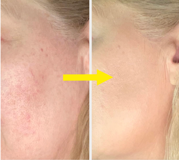 A side-by-side image showing a reviewer’s cheek before and after applying foundation, highlighting a flawless finish.