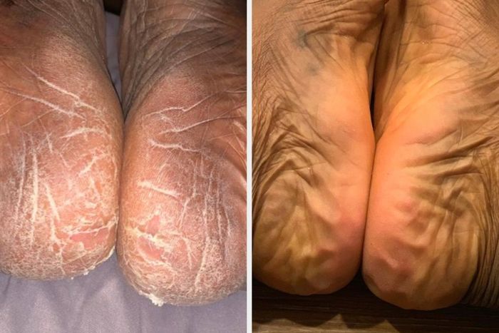 A before-and-after image highlighting cracked heels on the left and smooth, healthy heels on the right, demonstrating the product’s effectiveness.