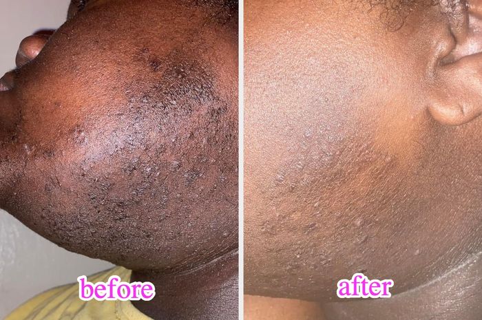 A reviewer shows their skin before and after using the toner pads to treat ingrown hair bumps.