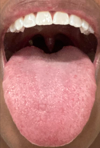 Close-up of an open mouth revealing a clean, scraped tongue.