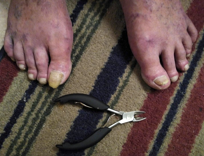 Toenails in need of trimming, resting on a striped rug with nail clippers beside them