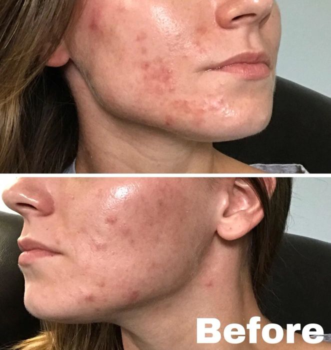 The reviewer's skin before using the cream