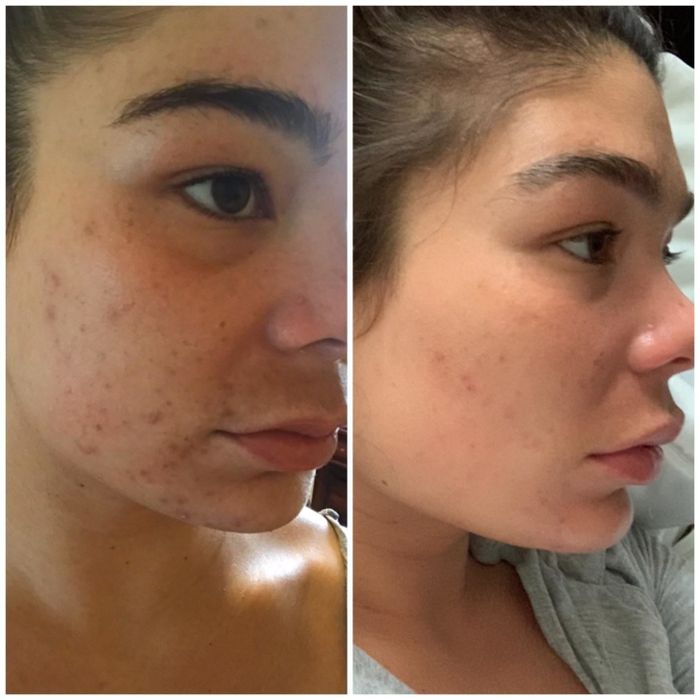 A before-and-after comparison of a reviewer with significant acne scars on their face, followed by a much clearer complexion with only 3-4 scars still visible.