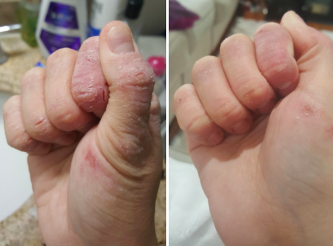 A before-and-after of a reviewer's extremely dry hand with numerous cracks and small cuts, compared to a much softer, smoother hand with only a couple of small dry patches remaining.