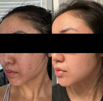 Before-and-after photos of a reviewer’s face showing visible skin improvement, with fewer blemishes in the second image.