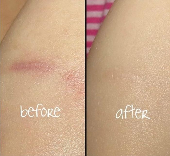 Before-and-after of a reviewer's red, slightly raised scar, which is almost completely faded after using Bio-Oil.