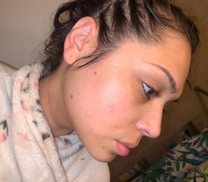 A reviewer showing off their smooth, clear skin with minimal blemishes.