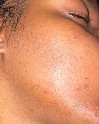 Reviewer's clear, glowing skin after using Differin gel