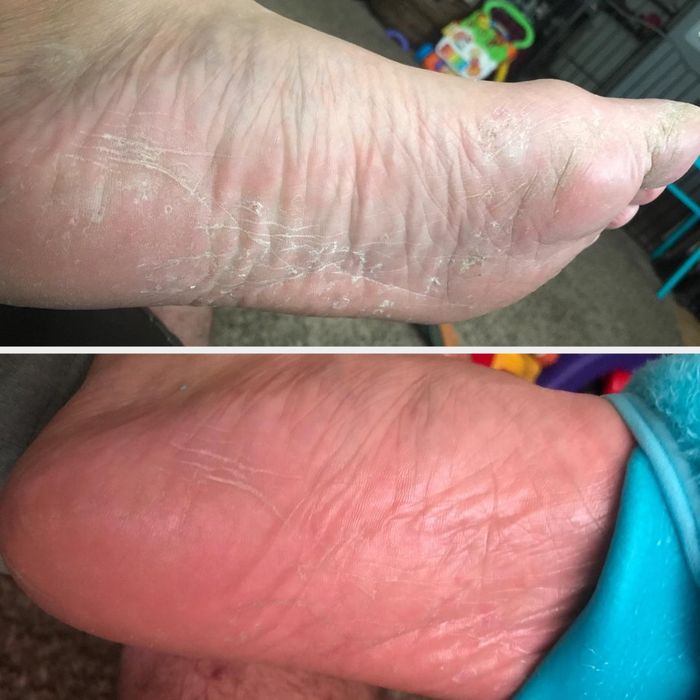 Before and after images of a foot, showing dry skin in the top image and smoother skin in the bottom image