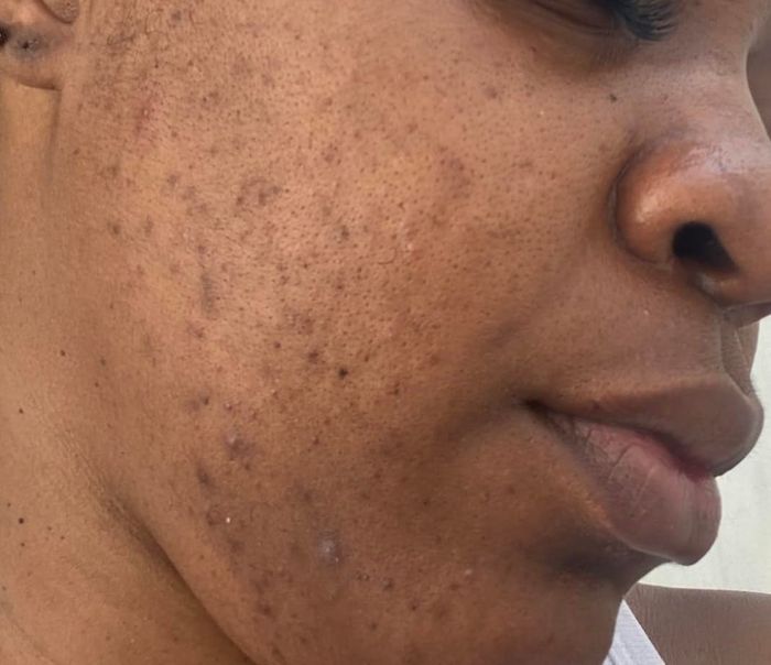 Close-up of a reviewer's skin texture and acne marks