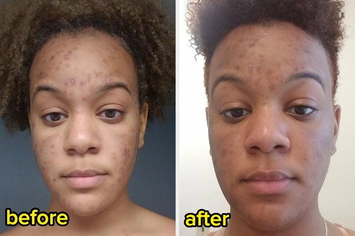 Side-by-side comparison showing a person's face with noticeable skin improvement, with descriptive text.