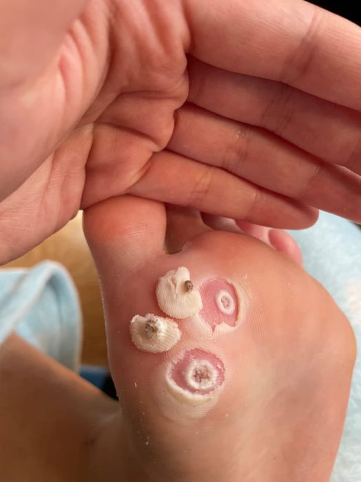 A close-up of a reviewer’s foot showing warts that have been successfully removed