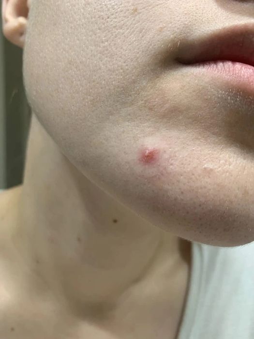 Reviewer's chin with a noticeable pimple and a pimple patch on top
