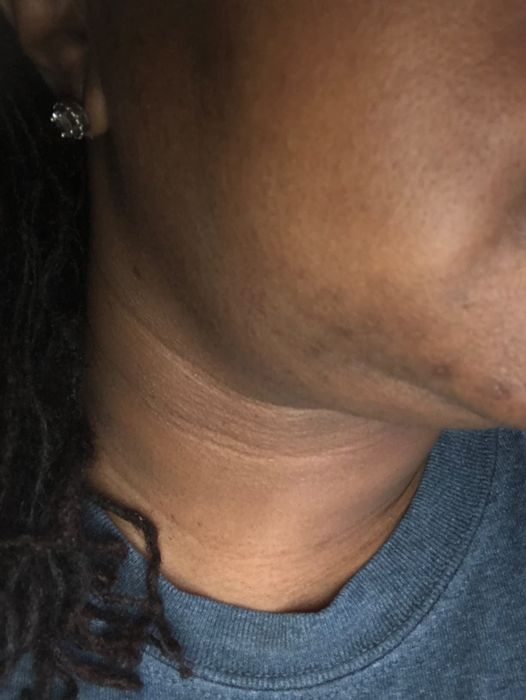 Close-up of the same reviewer's jawline and neck after using the mask, now displaying smooth skin and no visible blemishes.
