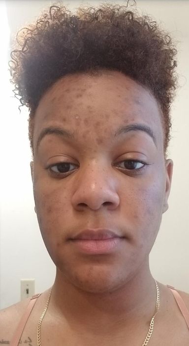 The same reviewer after using the product, showing an improved appearance of the scars.