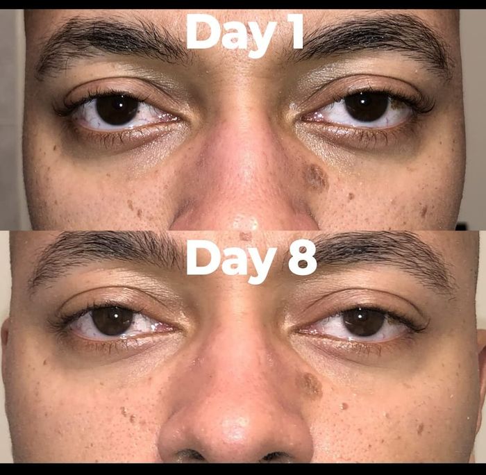 A close-up comparison of the reviewer's under-eye area, showcasing Day 1 and Day 8 of using the product, revealing reduced dark circles and puffiness.