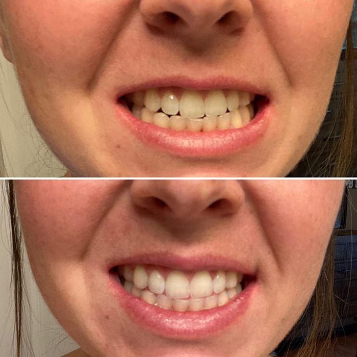 A before and after comparison of a reviewer's teeth showcasing the noticeable effects of using a teeth-whitening product.