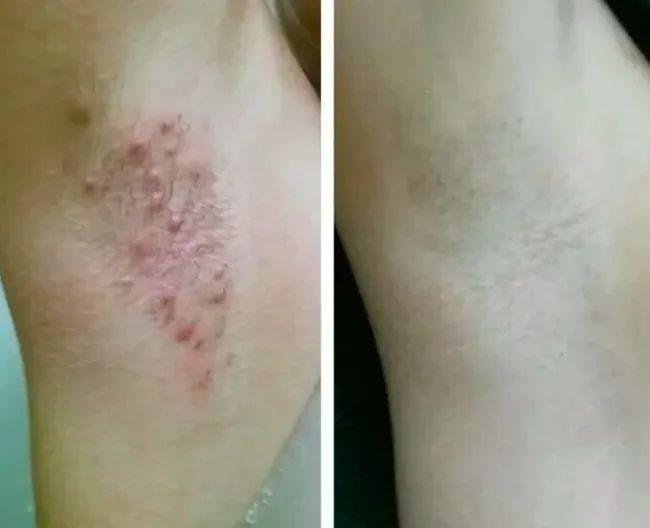 A before-and-after photo of a reviewer showing their red, bumpy armpit in the first image and a clear, smooth armpit in the second.