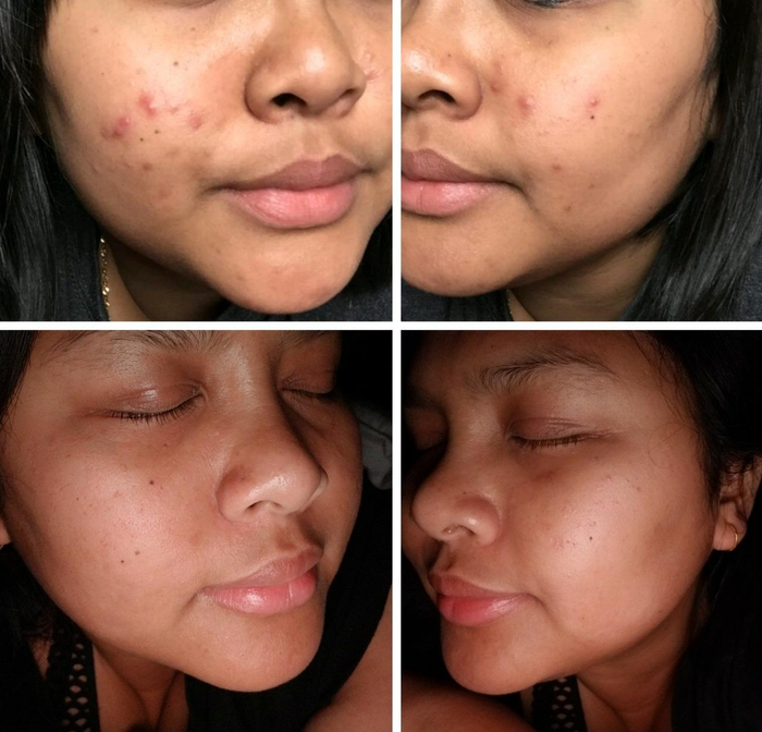 A four-panel collage shows a person’s face before and after using skincare. The top images show acne on the cheeks, while the bottom images reveal smooth, clear skin