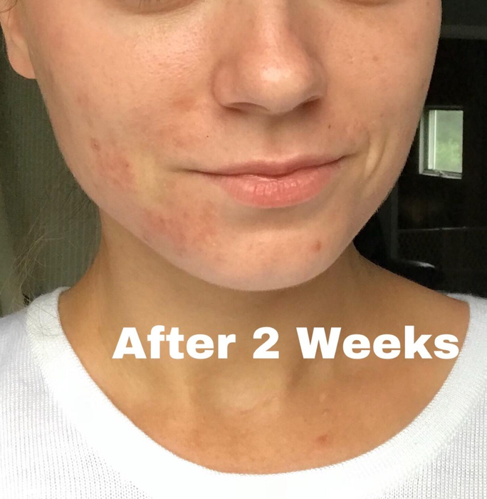 The reviewer's skin looks visibly clearer after two weeks of using the cream