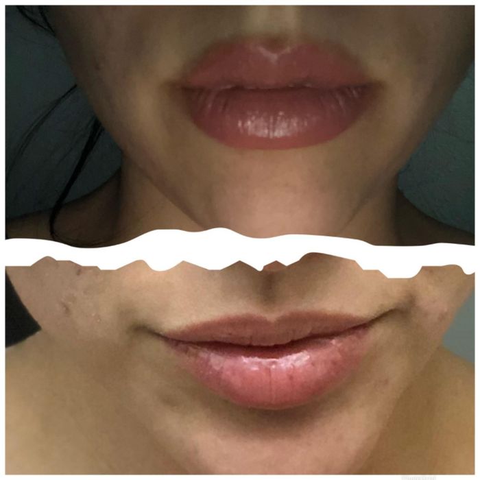 Before and after photos of a reviewer’s lips using the lip plumping set.