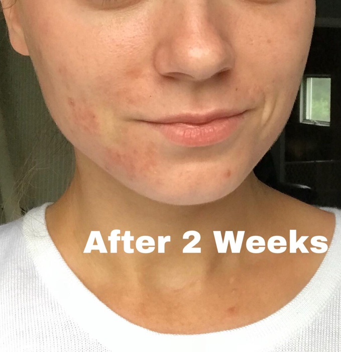 The reviewer’s skin after two weeks of using the Mizon snail repair cream, showing clearer skin.