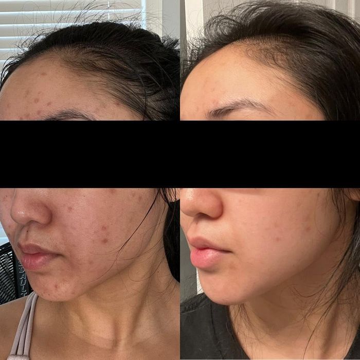 Before-and-after skincare shots revealing the improvement of acne scars on a reviewer's face
