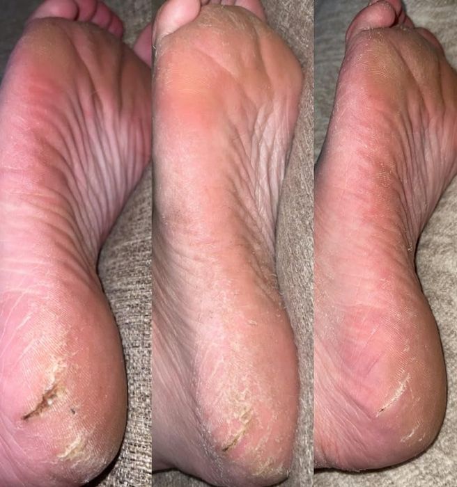 A collage of three close-up images showing the progression of dry, cracked heels with peeling skin