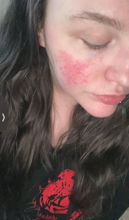 Close-up image of a reviewer's face, showcasing visible redness on their cheek