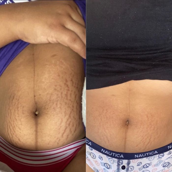 A reviewer with dark post-partum stretch marks that have noticeably lightened after using bio oil