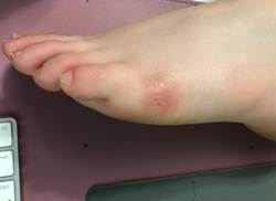 The reviewer's foot looking smooth and healed after the corn has fallen off