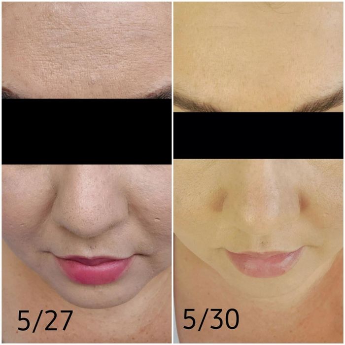 A reviewer's before and after pictures taken three days apart, showing how the spatula improved the texture of their skin and made their face appear smoother.