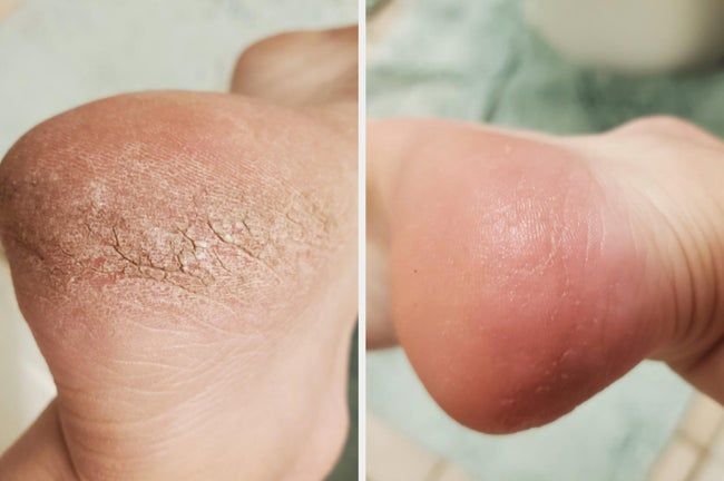 Before picture showing a cracked foot, and after, the skin is visibly smooth and softened.