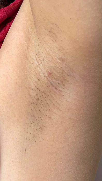 The same reviewer after 10 weeks, with their armpit hair visibly thinner.