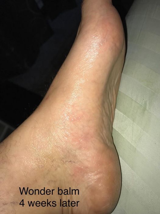 Same reviewer's foot after four weeks of consistent use, now fully healed and free from the red rash