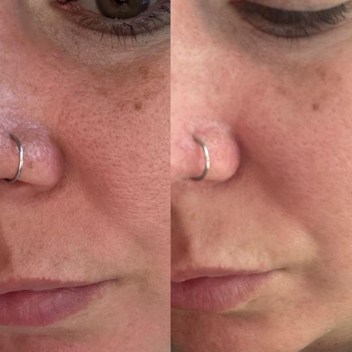Before and after shots showing the impressive difference in the reviewer's pores after using the toner pads to minimize their appearance