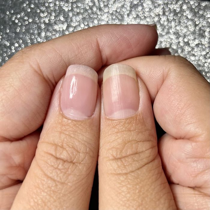 Close-up of two thumbs, one with a nail concealer and one without