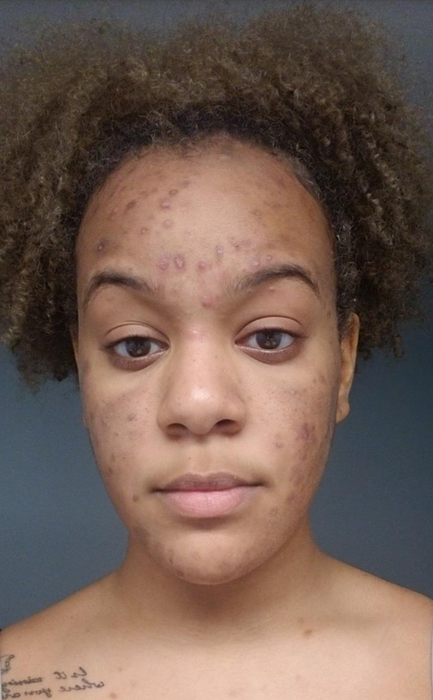 A selfie of a reviewer with acne and acne scars visible on their face