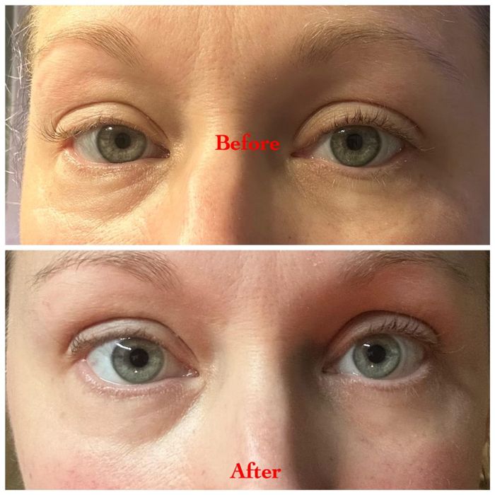 Before/after showing the reviewer's eyes looking less puffy and dark after using the eye masks.