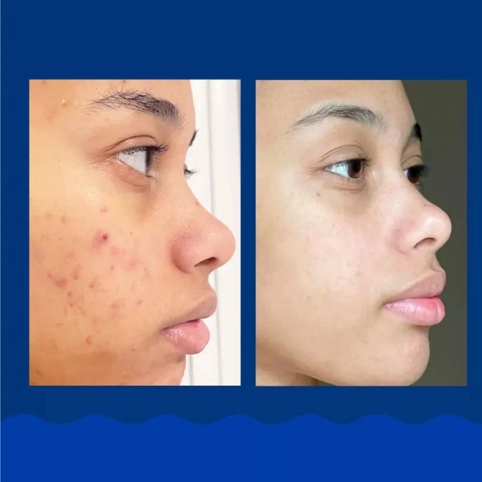 A side-by-side comparison image showing the improvement in a model's skin: acne on the left, clearer skin on the right after using the product.