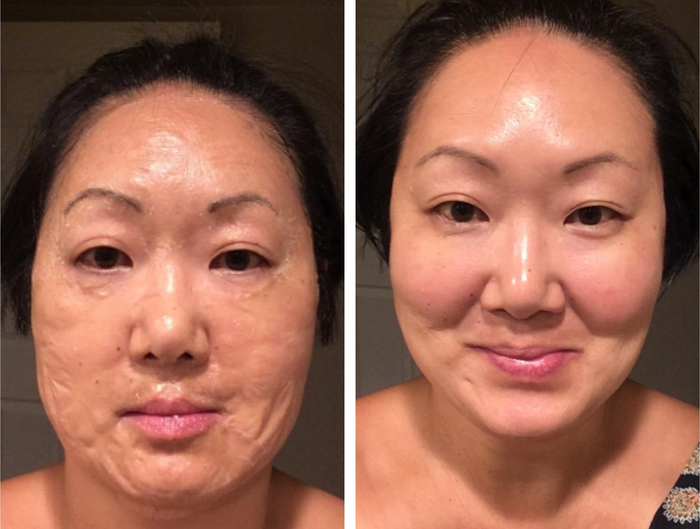 A split image of the reviewer wearing the mask and then their skin post-treatment