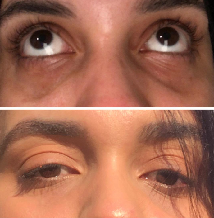 The reviewer’s under-eye area before and after using the hydrating stick, with dark circles visibly lighter