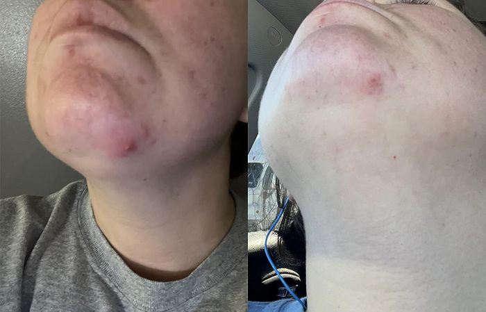 A reviewer's before and after shot showing their pimple before and after applying a patch