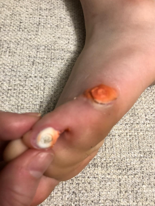 A close-up of the reviewer's foot showing two corns before treatment