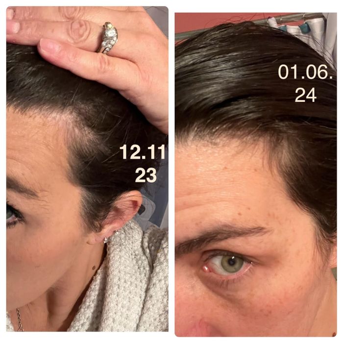 Side-by-side comparison of a reviewer's hairline before and after one month of use, showing noticeable growth at the temples