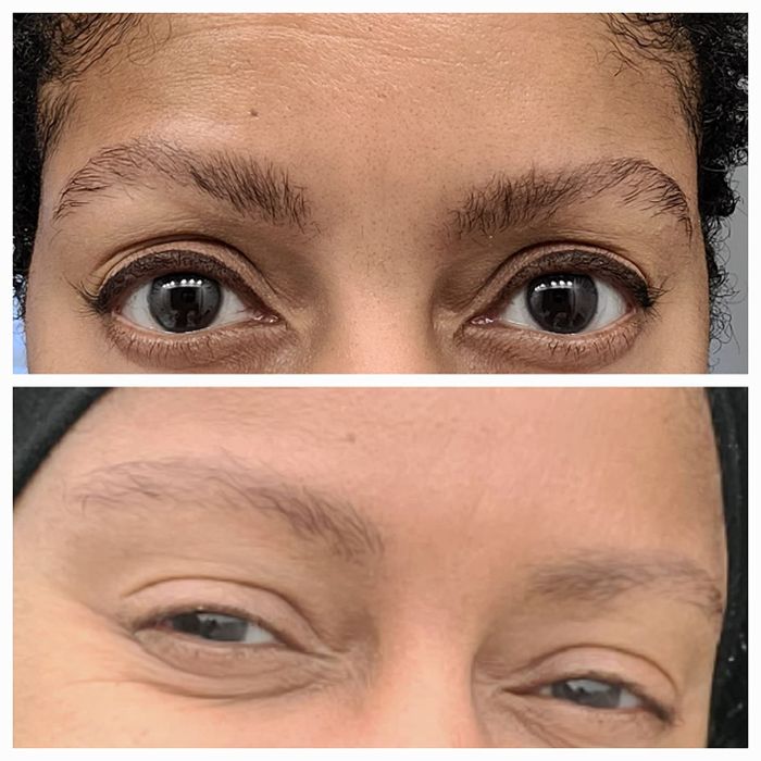 Top: Another reviewer shows their eyebrows thicker and fuller after using the serum. Bottom: Before photo showing how the reviewer’s eyebrows were thinner and less defined