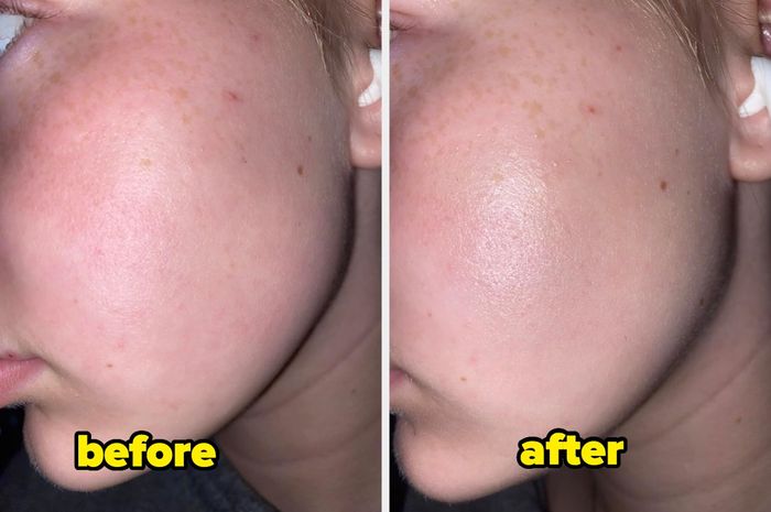 Side-by-side before and after images showing noticeable improvement in the texture of a person’s skin on their cheek. The left image is labeled.